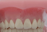 Animação mostrando a ortodontia lingual. O aparelho dessa técnica é invisível, pois fica atrás dos dentes
